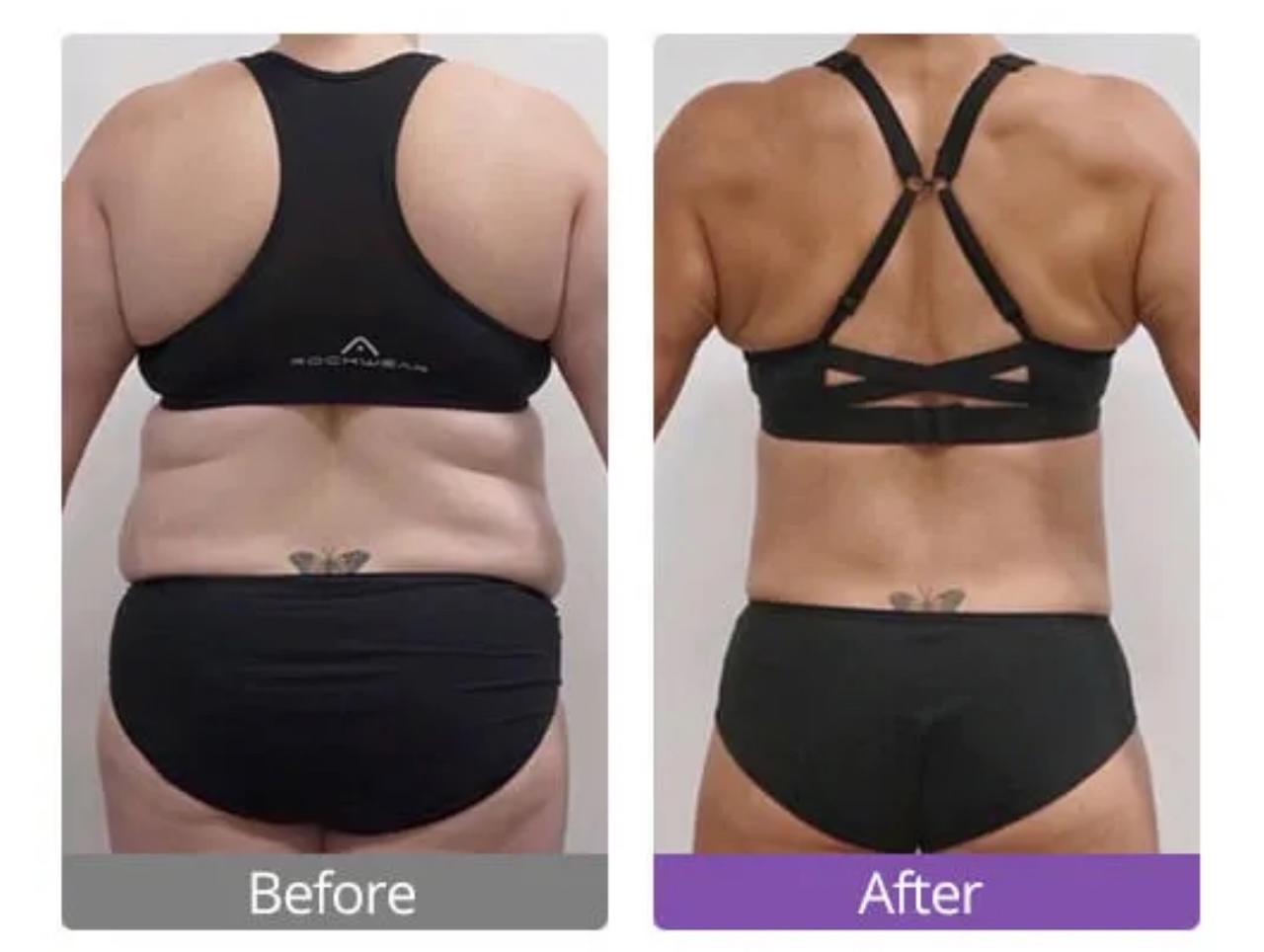 Cavitation IS All The Rave!  Get in Shape for Summer!
