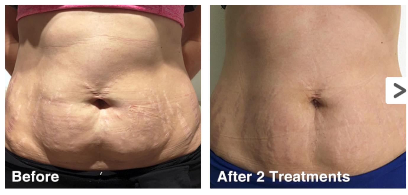Summer IS JUST Around The Corner:  Get In Shape Fast With Cavitation Losing Inches